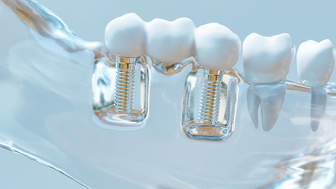 Implant Model